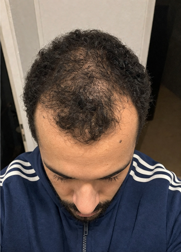Before - Lorenzo